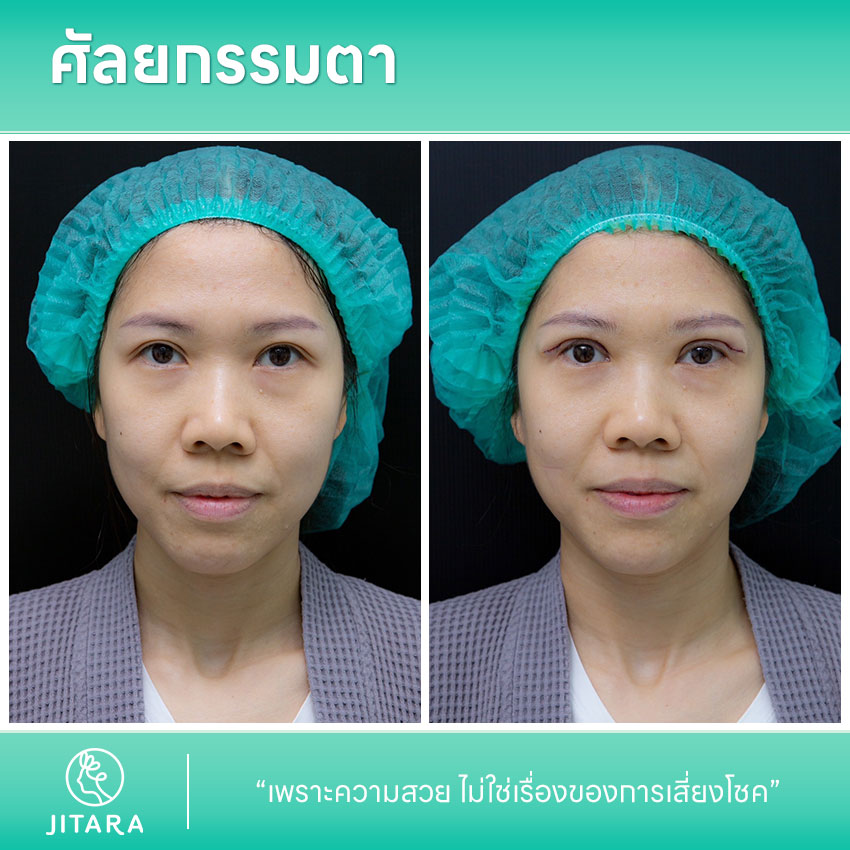ศัลยกรรมตา